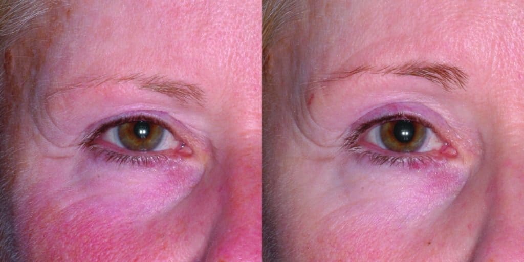 ULTHERAPY BEFORE & AFTER PHOTO.