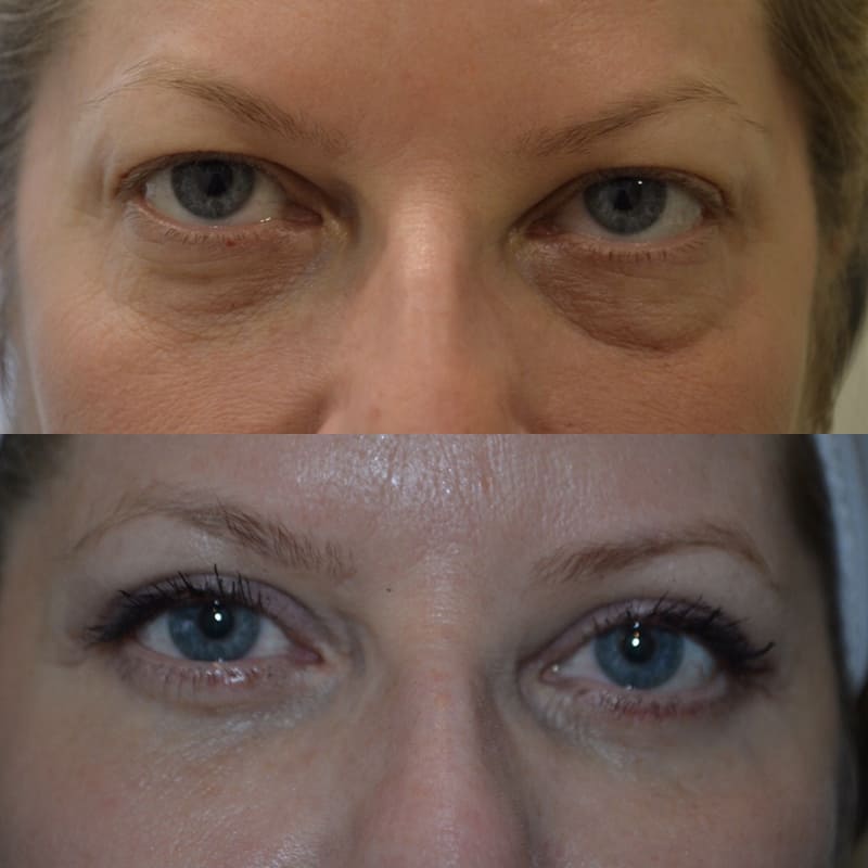 UPPER & LOWER EYELID SURGERY (BLEPHAROPLASTY) BEFORE & AFTER PHOTO. SURGERY BY DR. BALJEET K. PUREWAL (OCULOPLASTIC SURGEON) IN NEW JERSEY.