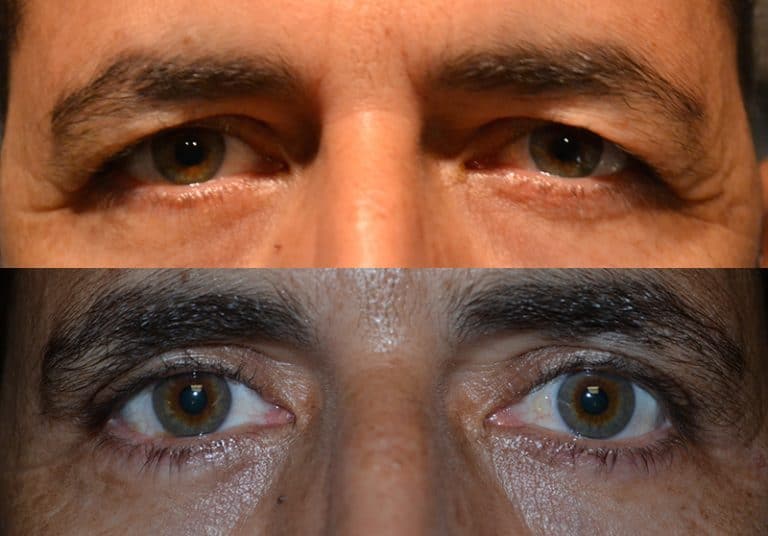 UPPER EYELID SURGERY (BLEPHAROPLASTY) BEFORE & AFTER PHOTO. SURGERY BY DR. BALJEET K. PUREWAL (OCULOPLASTIC SURGEON) IN NEW JERSEY.