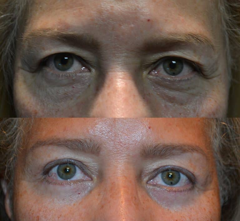 UPPER & LOWER EYELID SURGERY (BLEPHAROPLASTY) BEFORE & AFTER PHOTO. SURGERY BY DR. BALJEET K. PUREWAL (OCULOPLASTIC SURGEON) IN NEW JERSEY.