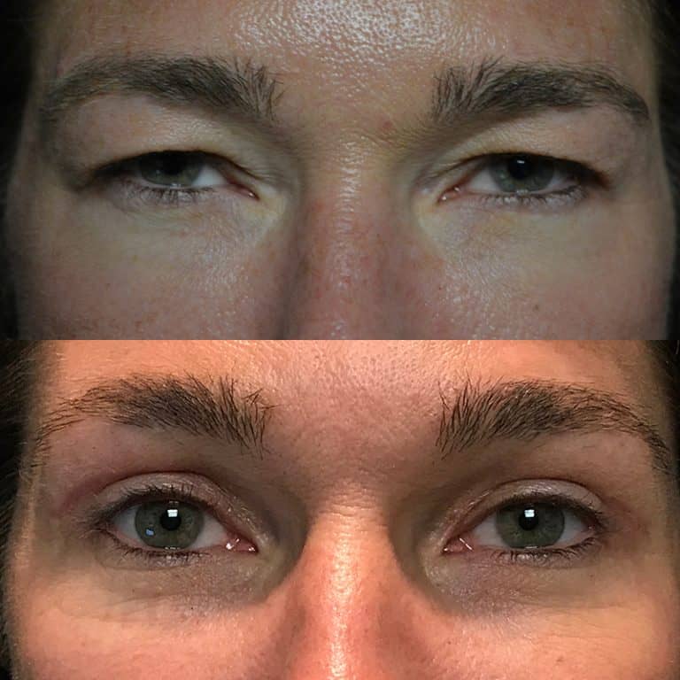 UPPER EYELID SURGERY (BLEPHAROPLASTY) BEFORE & AFTER PHOTO. SURGERY BY DR. BALJEET K. PUREWAL (OCULOPLASTIC SURGEON) IN NEW JERSEY.