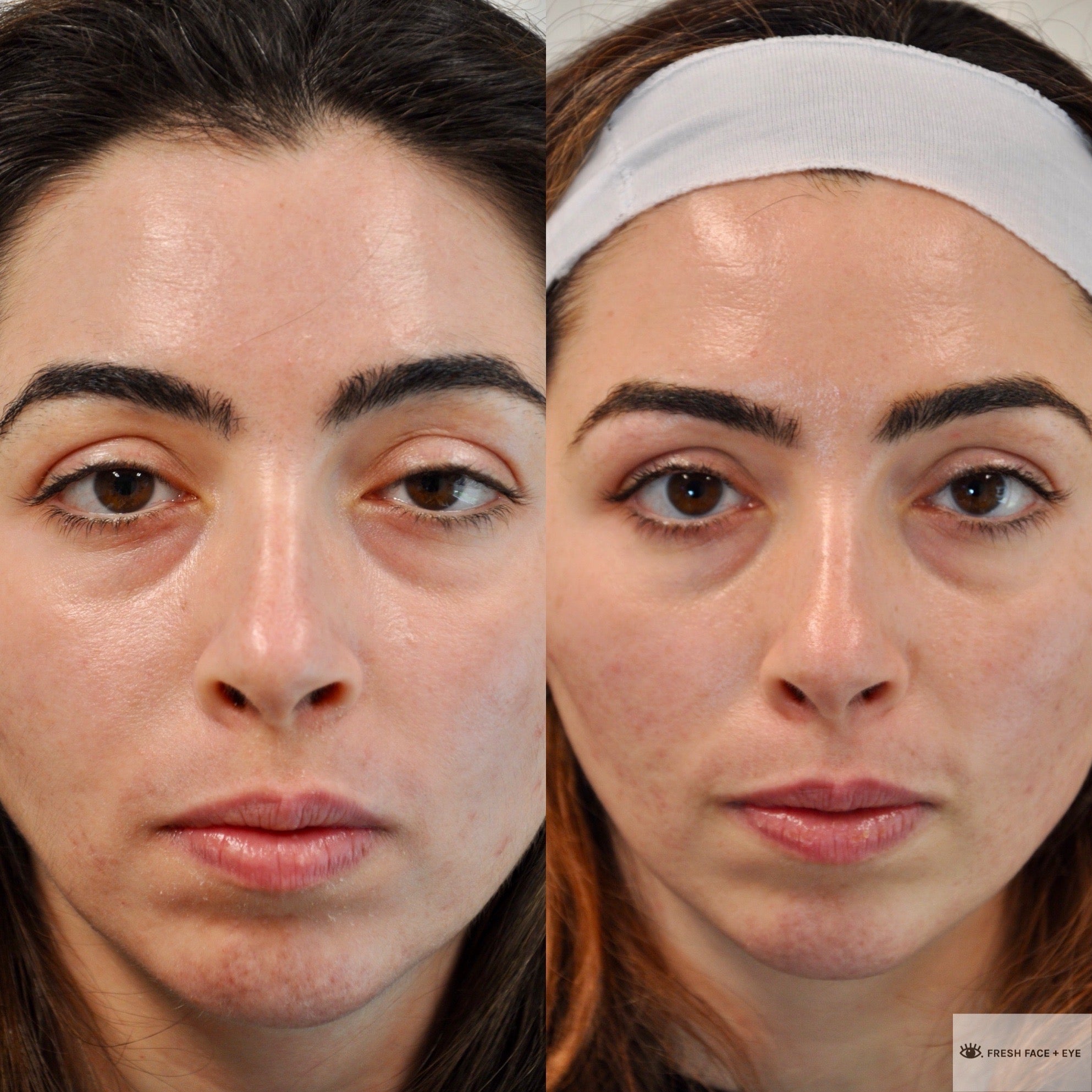 PTOSIS REPAIR BEFORE & AFTER PHOTO. PROCEDURE BY DR. BALJEET K. PUREWAL (OCULOPLASTIC SURGEON) IN NEW JERSEY.
