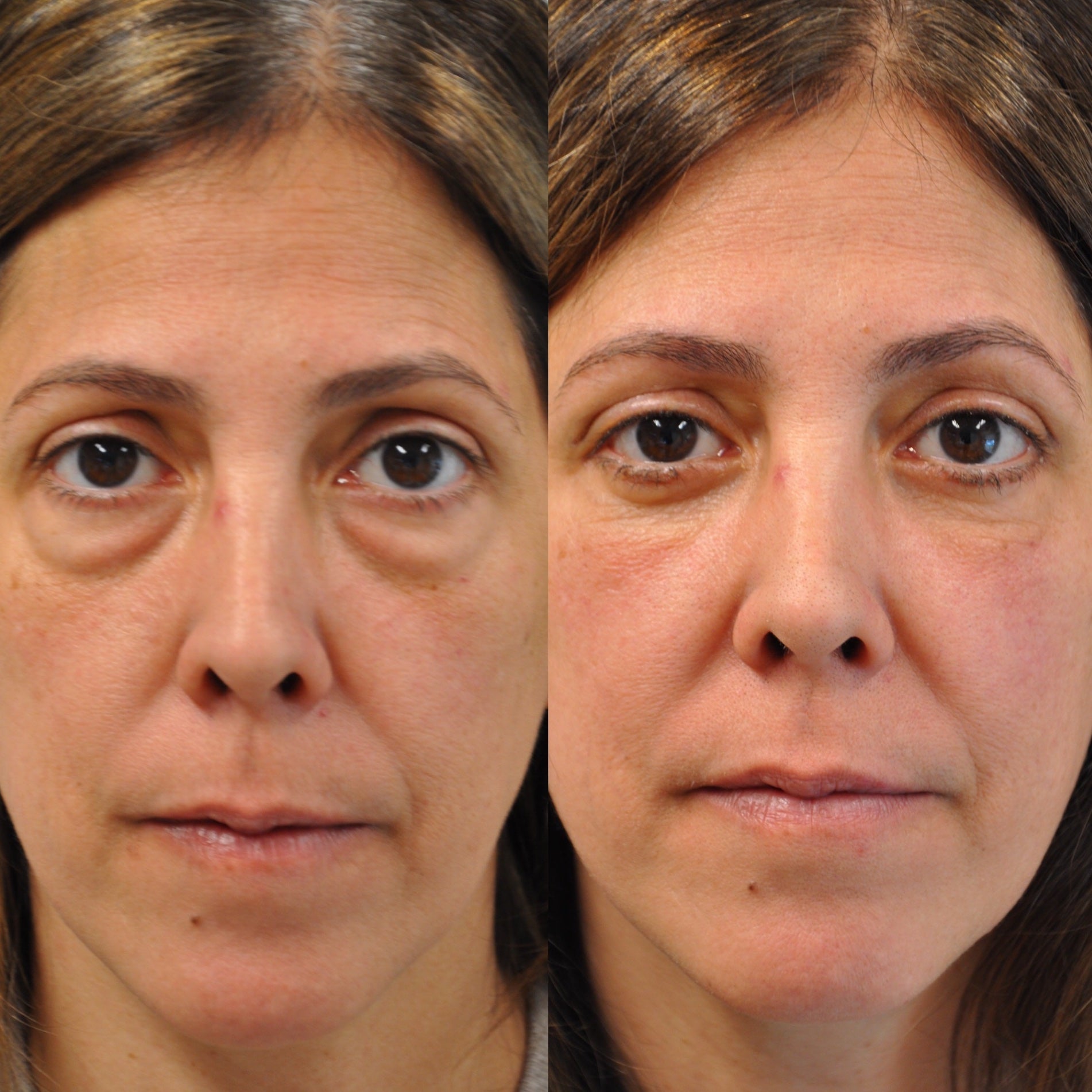 LOWER EYELID SURGERY (BLEPHAROPLASTY) BEFORE & AFTER PHOTO. SURGERY BY DR. BALJEET K. PUREWAL (OCULOPLASTIC SURGEON) IN NEW JERSEY