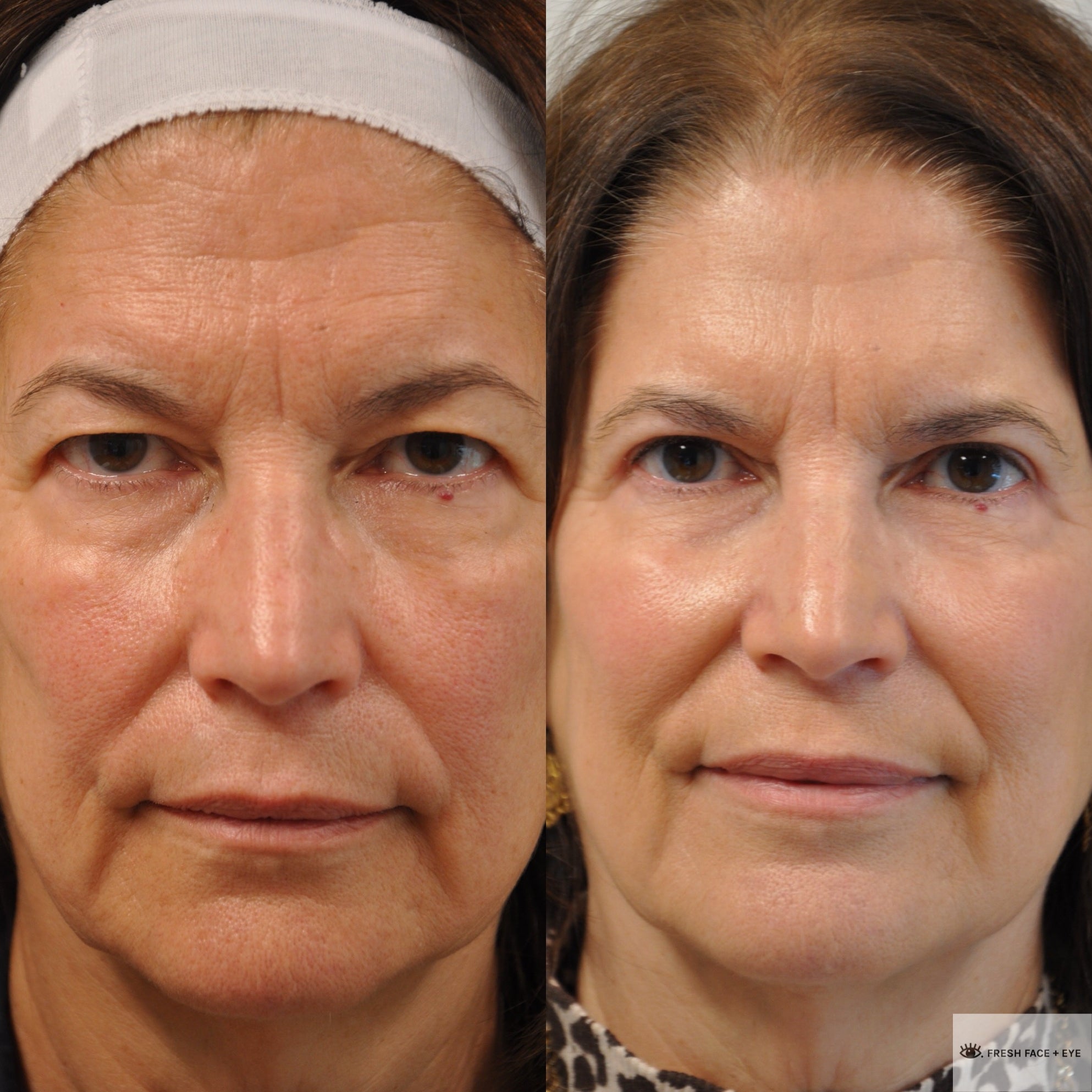 UPPER EYELID SURGERY (BLEPHAROPLASTY) BEFORE & AFTER PHOTO. SURGERY BY DR. BALJEET K. PUREWAL (OCULOPLASTIC SURGEON) IN NEW JERSEY.