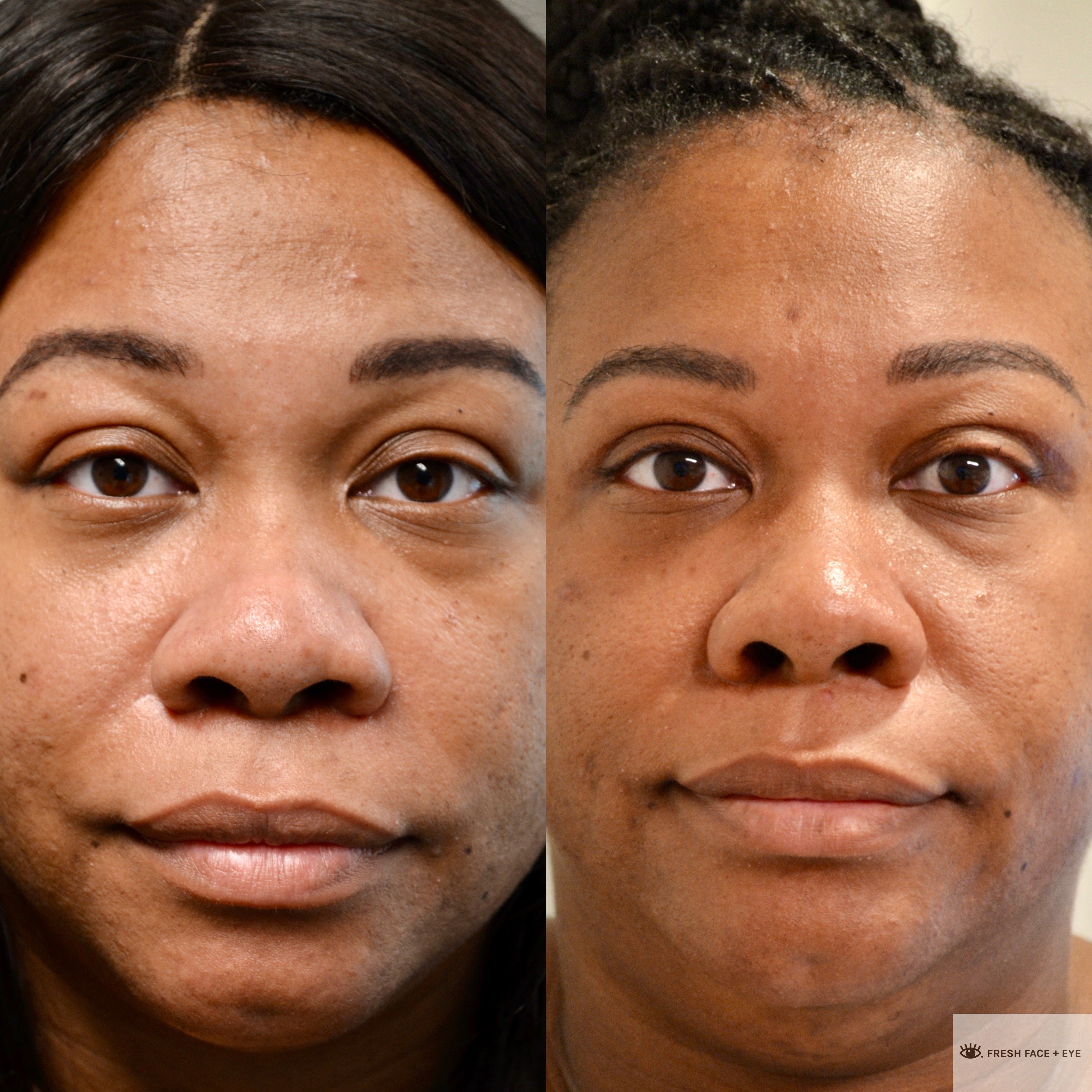 UPPER EYELID SURGERY (BLEPHAROPLASTY) BEFORE & AFTER PHOTO. SURGERY BY DR. BALJEET K. PUREWAL (OCULOPLASTIC SURGEON) IN NEW JERSEY.