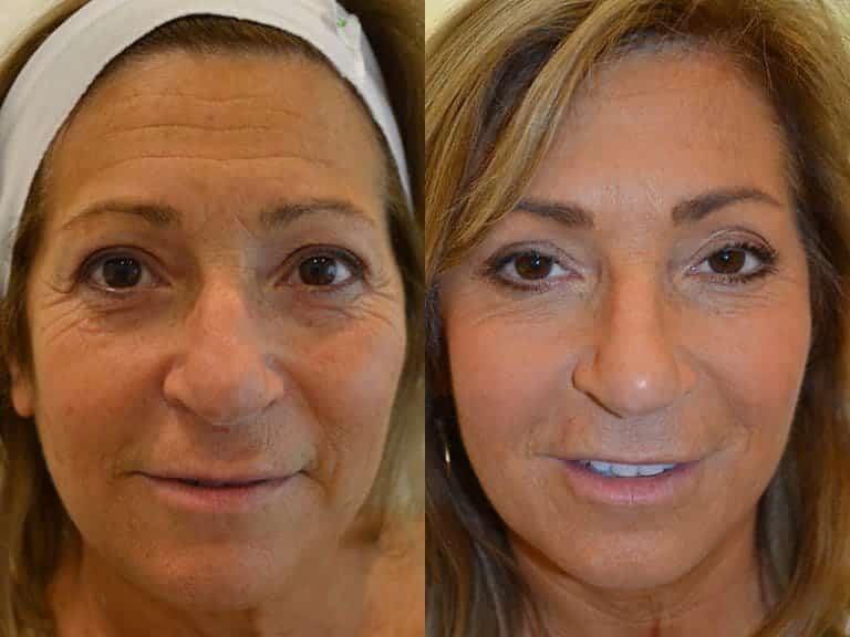 COMBINATION THERAPY BEFORE & AFTER PHOTO. PROCEDURE BY DR. BALJEET K. PUREWAL (OCULOPLASTIC SURGEON) IN NEW JERSEY.