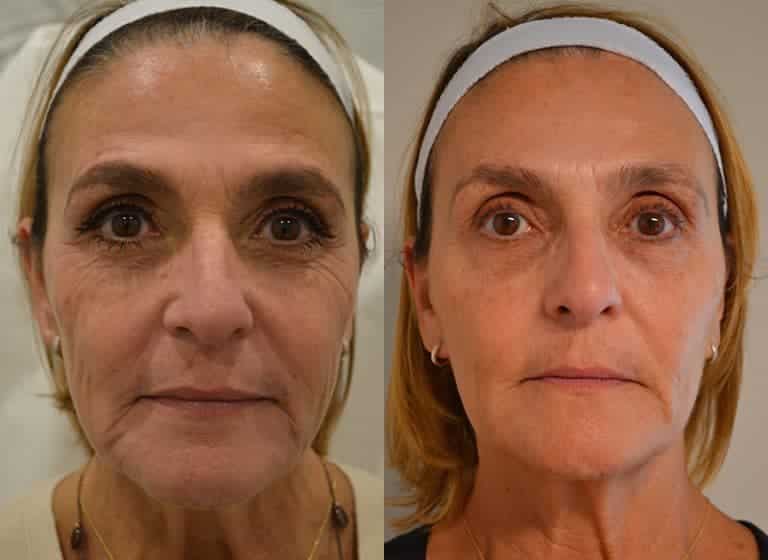 COMBINATION THERAPY BEFORE & AFTER PHOTO. PROCEDURE BY DR. BALJEET K. PUREWAL (OCULOPLASTIC SURGEON) IN NEW JERSEY.