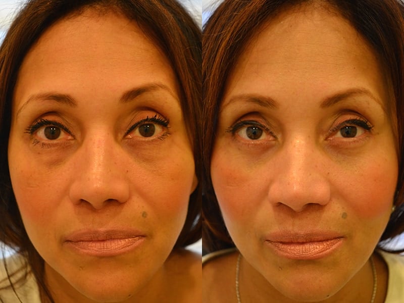 LOWER EYELID SURGERY (BLEPHAROPLASTY) BEFORE & AFTER PHOTO. SURGERY BY DR. BALJEET K. PUREWAL (OCULOPLASTIC SURGEON) IN NEW JERSEY.
