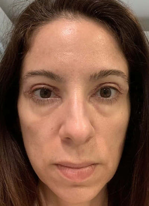 Upper Eyelid Surgery Healing Case: Day 1