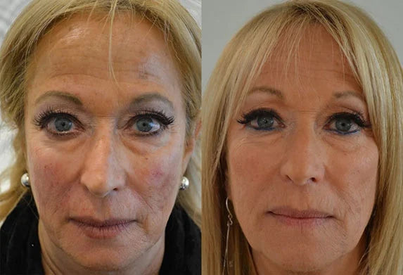DERMAL FILLER BEFORE & AFTER PHOTO. PROCEDURE PERFORMED BY DR. BALJEET K. PUREWAL (OCULOPLASTIC SURGEON) IN NEW JERSEY.