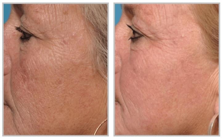 HALO LASER BEFORE & AFTER PHOTO