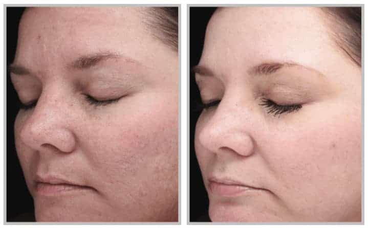 HALO LASER BEFORE & AFTER PHOTO