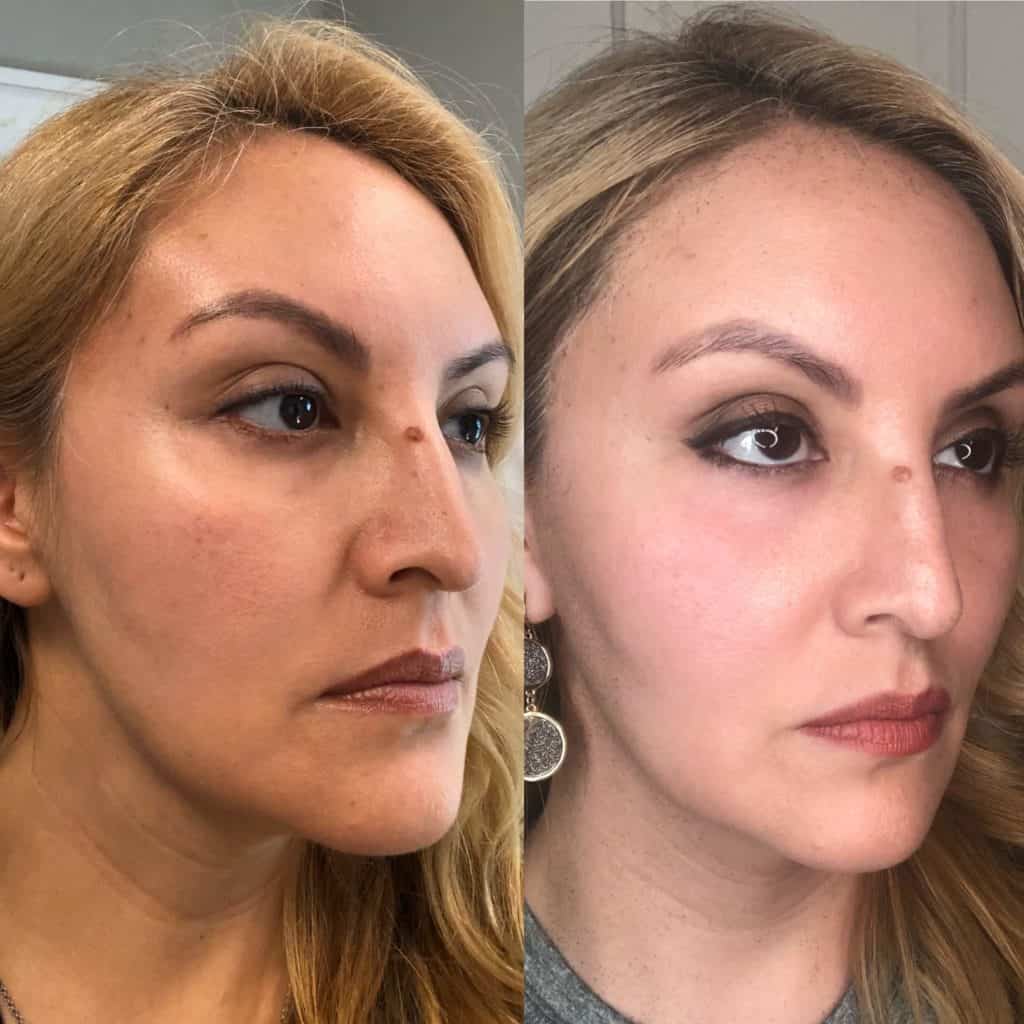 HALO LASER BEFORE & AFTER PHOTO.