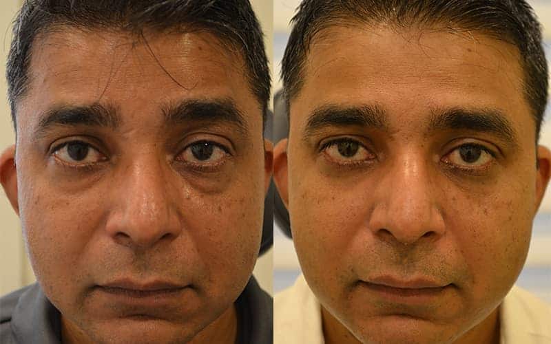 LOWER EYELID SURGERY (BLEPHAROPLASTY) BEFORE & AFTER PHOTO. SURGERY BY DR. BALJEET K. PUREWAL (OCULOPLASTIC SURGEON) IN NEW JERSEY.