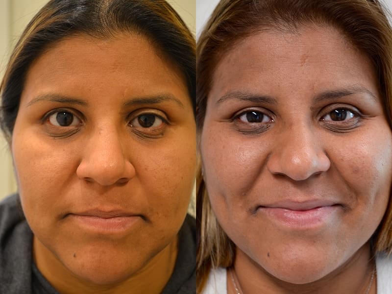 PTOSIS REPAIR BEFORE & AFTER PHOTO. PROCEDURE BY DR. BALJEET K. PUREWAL (OCULOPLASTIC SURGEON) IN NEW JERSEY.
