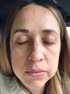 Broadband Light (BBL) Photofacial Healing Case: Day 3