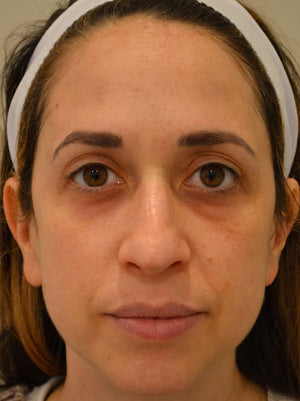 Broadband Light (BBL) Photofacial Healing Case: Two Weeks