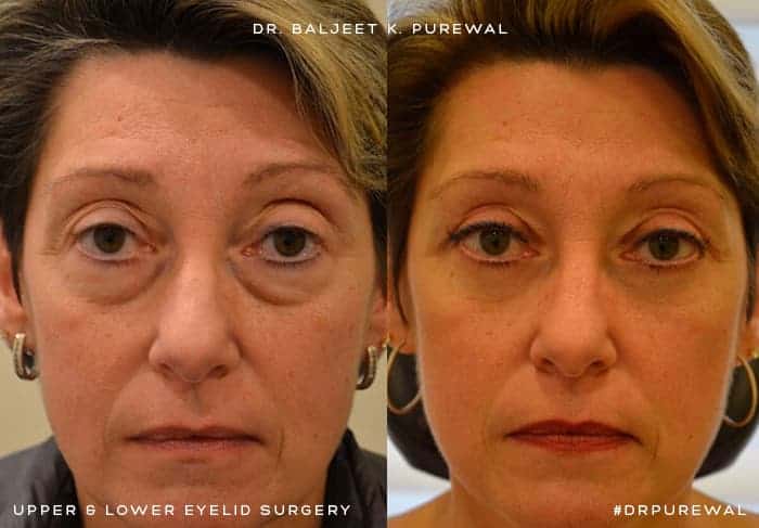 UPPER & LOWER EYELID SURGERY (BLEPHAROPLASTY) BEFORE & AFTER PHOTO. SURGERY BY DR. BALJEET K. PUREWAL (OCULOPLASTIC SURGEON) IN NEW JERSEY.