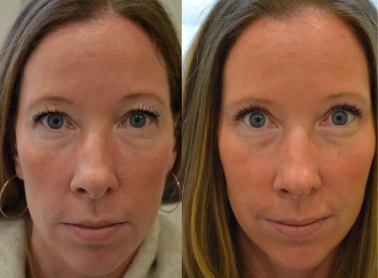 UPPER EYELID SURGERY (BLEPHAROPLASTY) BEFORE & AFTER PHOTO. SURGERY BY DR. BALJEET K. PUREWAL (OCULOPLASTIC SURGEON) IN NEW JERSEY.