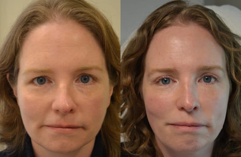 UPPER EYELID SURGERY (BLEPHAROPLASTY) BEFORE & AFTER PHOTO. SURGERY BY DR. BALJEET K. PUREWAL (OCULOPLASTIC SURGEON) IN NEW JERSEY.