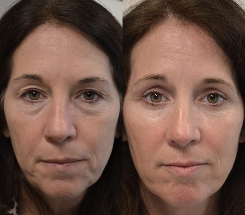 UPPER & LOWER EYELID SURGERY (BLEPHAROPLASTY) BEFORE & AFTER PHOTO. SURGERY BY DR. BALJEET K. PUREWAL (OCULOPLASTIC SURGEON) IN NEW JERSEY