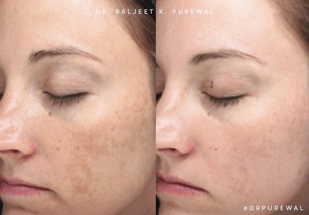 Halo laser uses both ablative and non-ablative wavelengths that work together to give you the gorgeous, glowing skin of your youth.