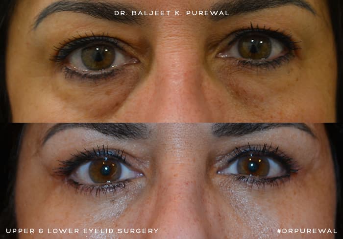 Upper & Lower Eyelid Surgery (Blepharoplasty) Before & After Photo. Surgery by Dr. Baljeet K. Purewal (Oculoplastic Surgeon) in New Jersey.