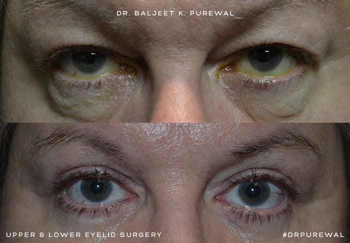 Upper & Lower Eyelid Surgery (Blepharoplasty) Before & After Photo. Surgery by Dr. Baljeet K. Purewal (Oculoplastic Surgeon) in New Jersey.