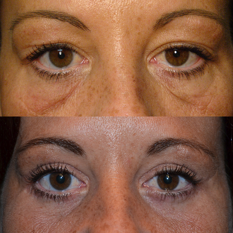 Upper & Lower Eyelid Surgery (Blepharoplasty) Before & After Photo. Surgery by Dr. Baljeet K. Purewal (Oculoplastic Surgeon) in New Jersey.