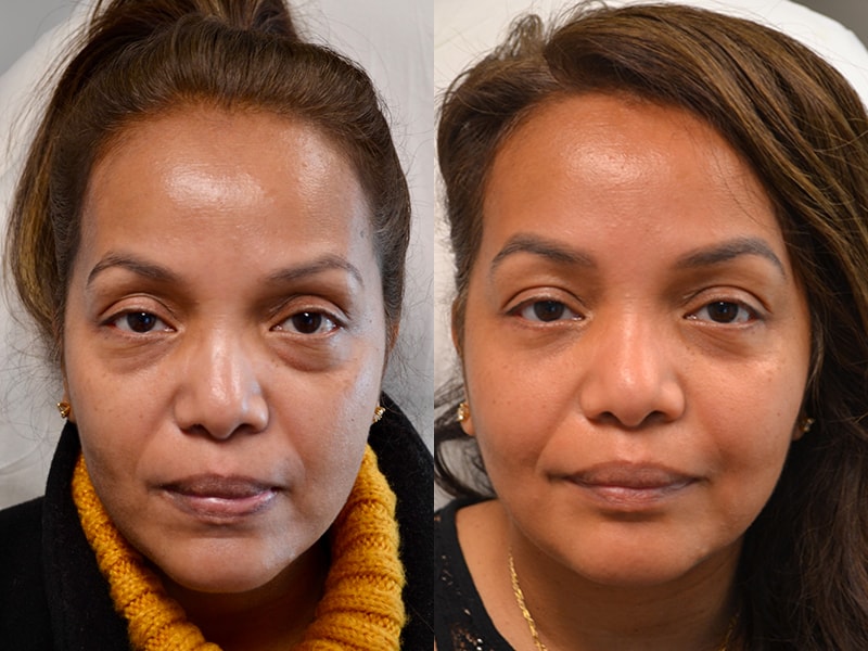 lower eyelid surgery before and after of woman aged 40 to 45 years, fixing dark circles under eyes