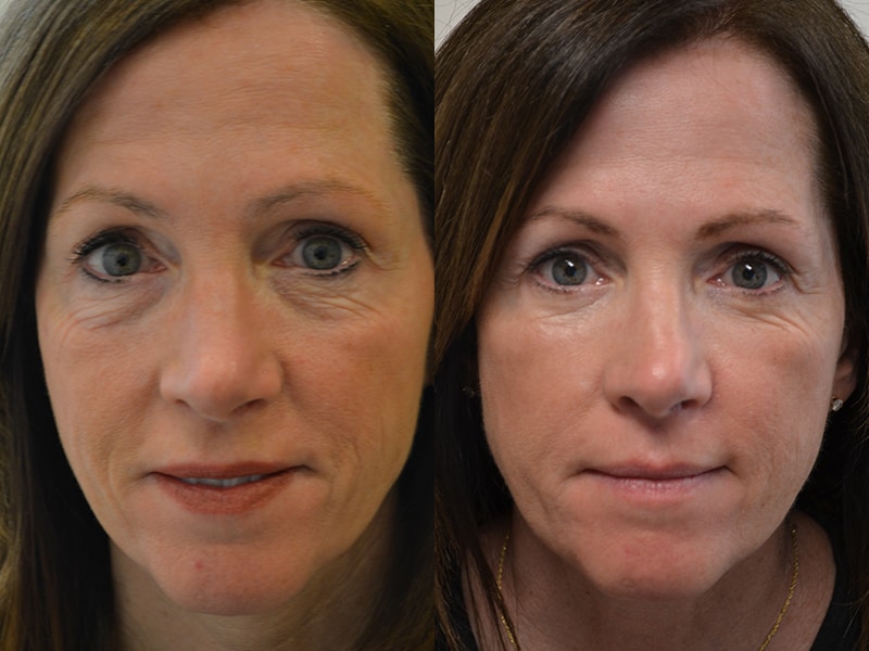 lower blepharoplasty before and after of woman in her sixties by Dr. Baljeet Purewal