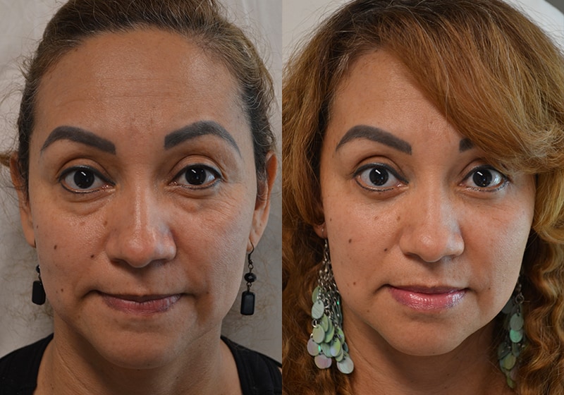 lower blepharoplasty before and after of woman aged 40 to 45 years, fixing puffiness of lower eyelids