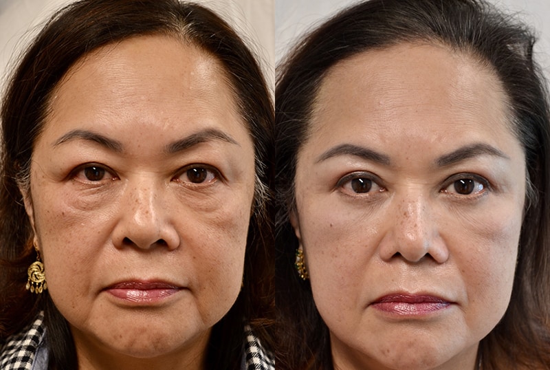 full face upper and lower blepharoplasty before and after of woman with brown eyes