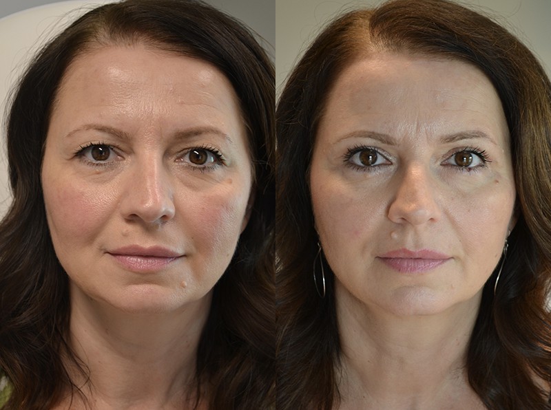 bilateral upper blepharoplasty before and after results of a woman aged 50 to 55, fixing loose eyelids