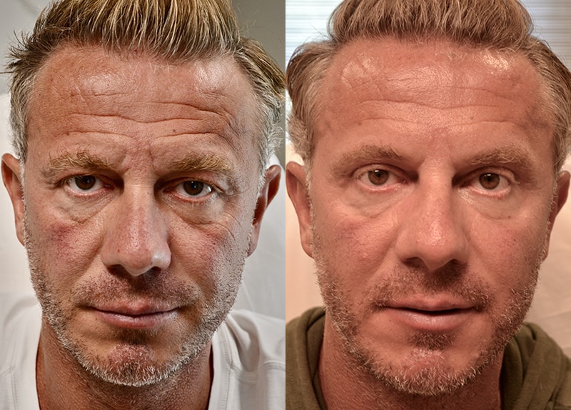 bilateral upper blepharoplasty before and after results of a man aged 45 to 50