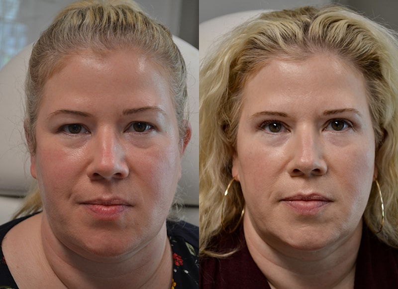 upper eyelid surgery before and after results of a woman aged 45 to 50