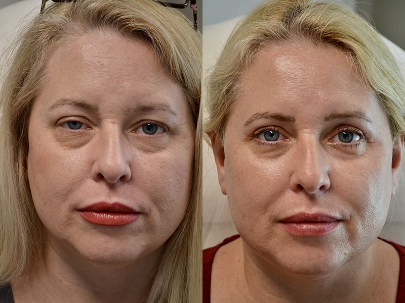 blepharoplasty and ptosis surgery before and after of woman aged 45 to 50