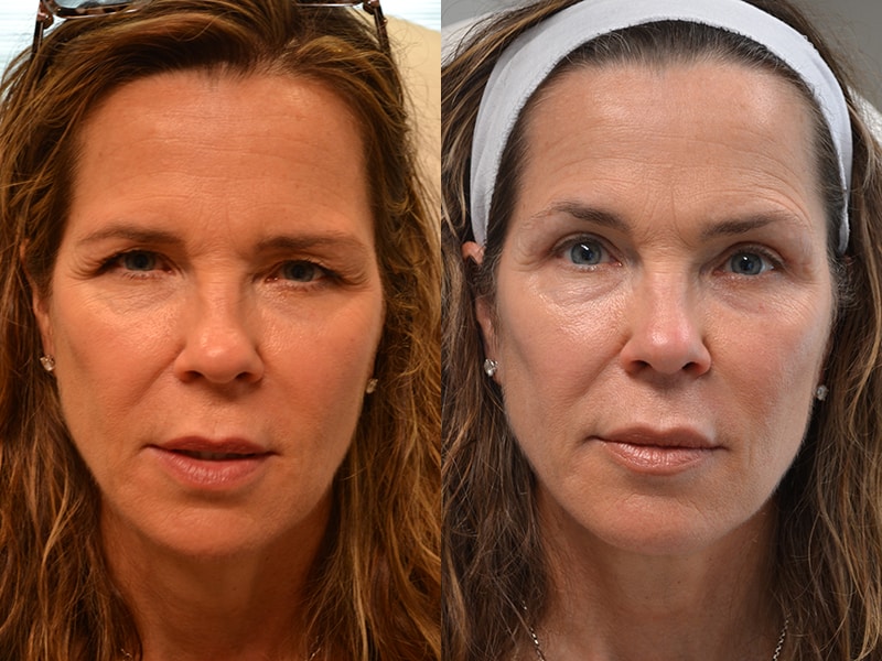 upper eyelid surgery before and after results of a woman aged 55 to 60