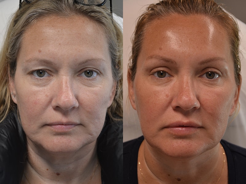 bilateral upper blepharoplasty before and after results of a woman aged 45 to 50