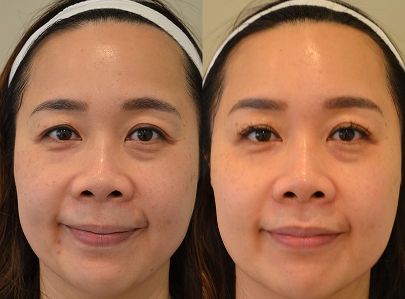 bbl skin treatment before and after for 40 to 45 year old woman, fixing pigmentation