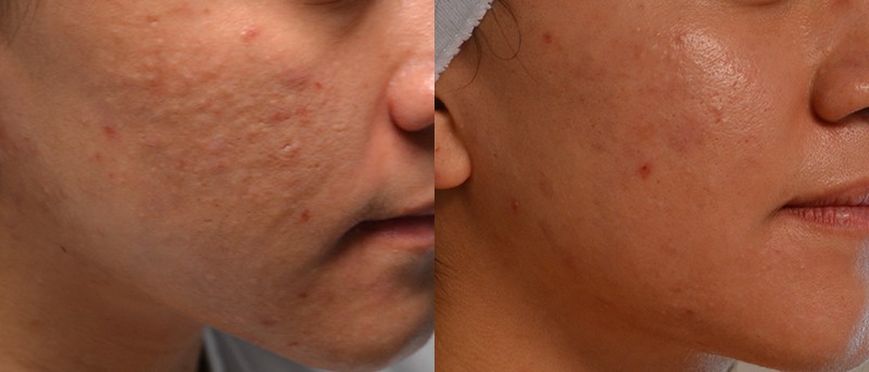 bbl face treatment before and after of 20-25 year old woman's cheeks, clearing acne scarring