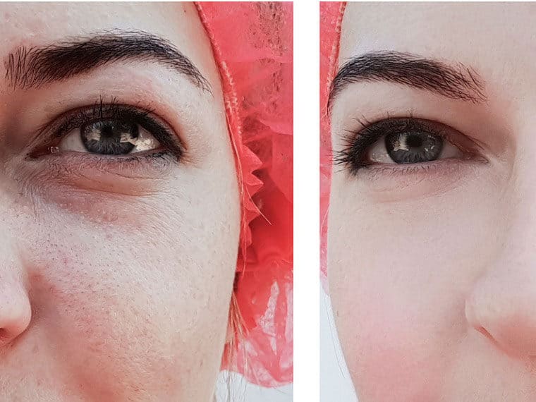 woman's before and after skin care results