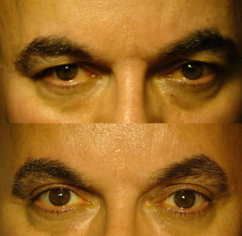 upper eyelid surgery before and after results of a man aged 50 to 55