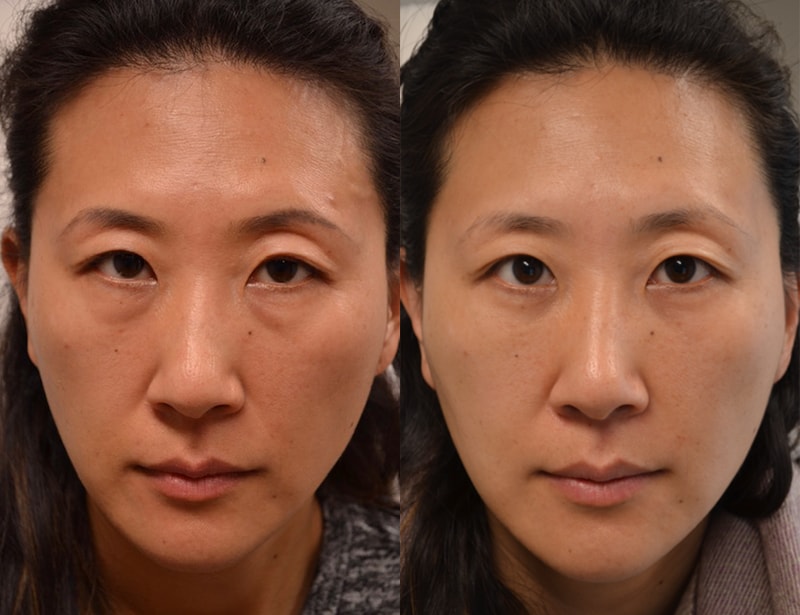 bilateral lower lid blepharoplasty before and after for Asian woman between 40 and 45, fixing puffiness