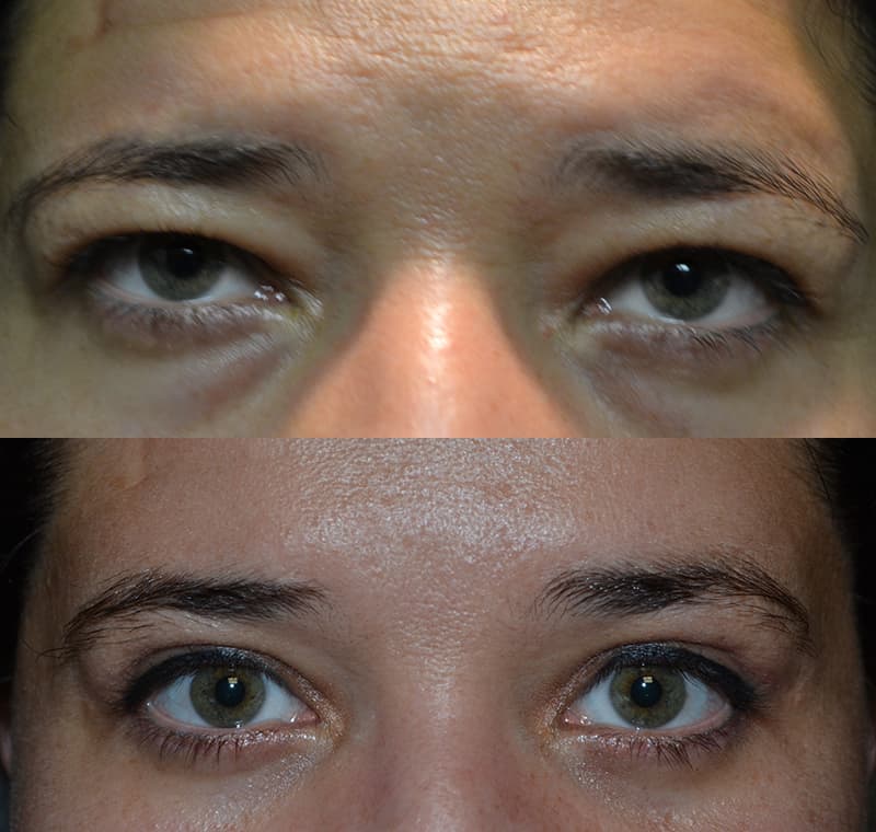 person with hazel eyes before and after for upper and lower blepharoplasty