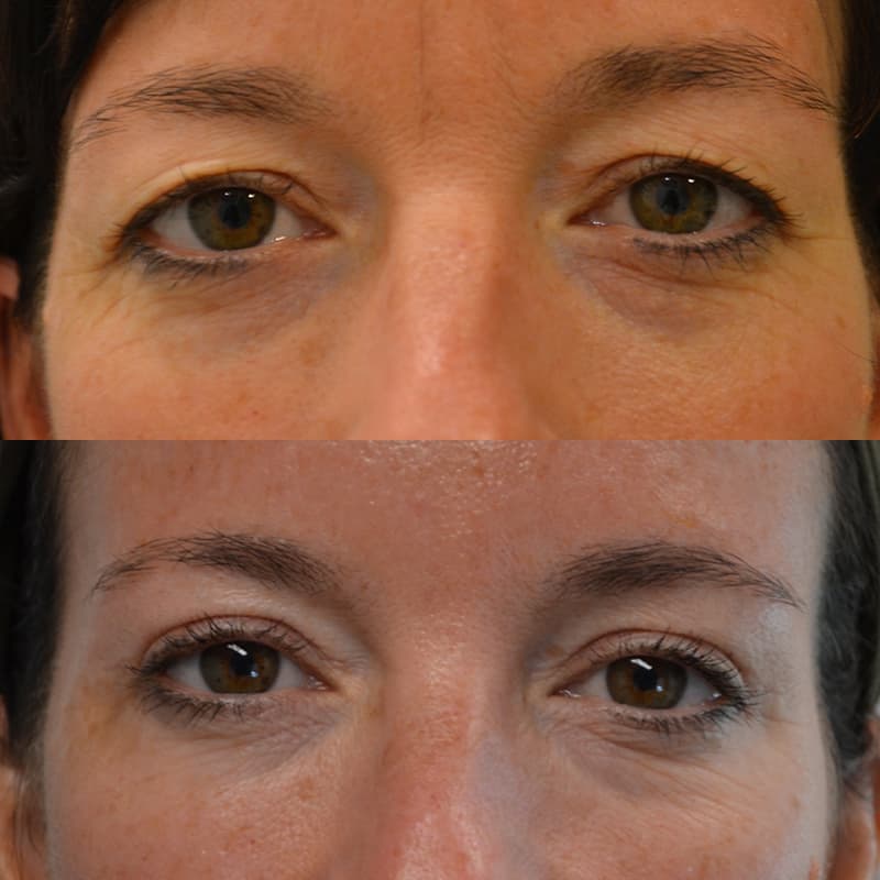bilateral upper blepharoplasty before and after results of a woman aged 45 to 50, fixing heavy eyelids