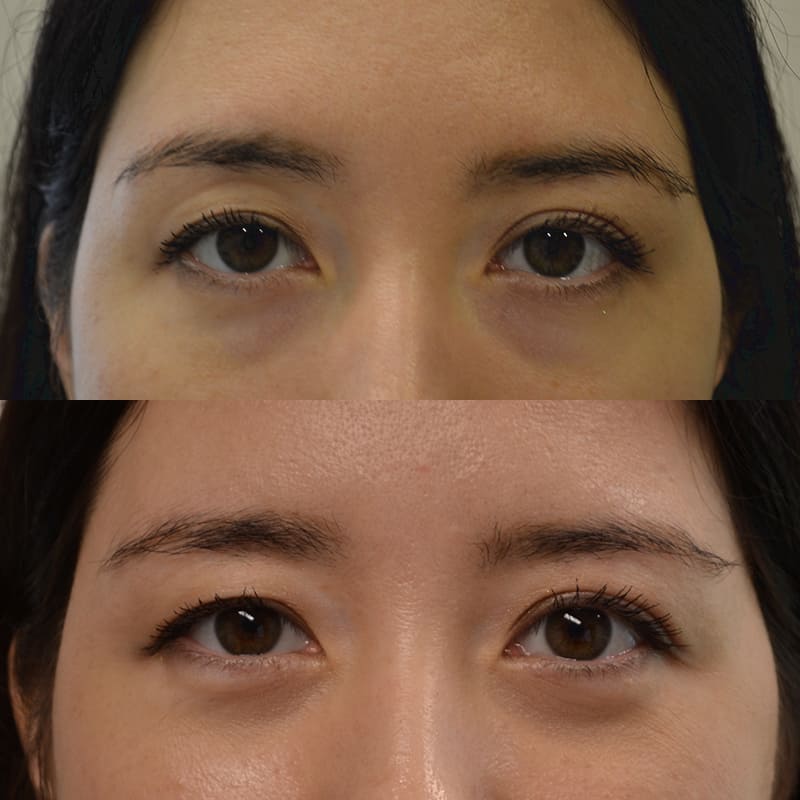 Dr. Purewal's lower blepharoplasty before and after for woman aged 30 to 35