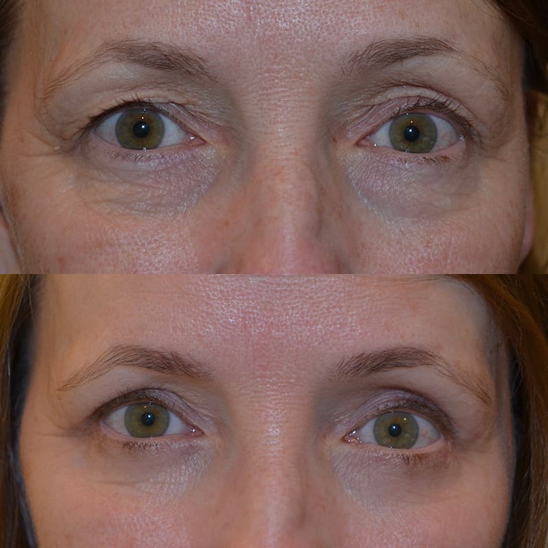woman with hazel eyes before and after for upper and lower blepharoplasty