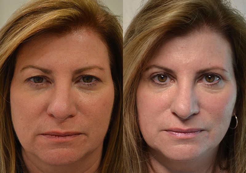 bilateral upper blepharoplasty before and after results of a woman aged 55 to 60