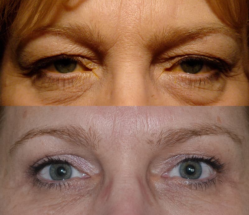 woman with blue eyes before and after for upper and lower blepharoplasty
